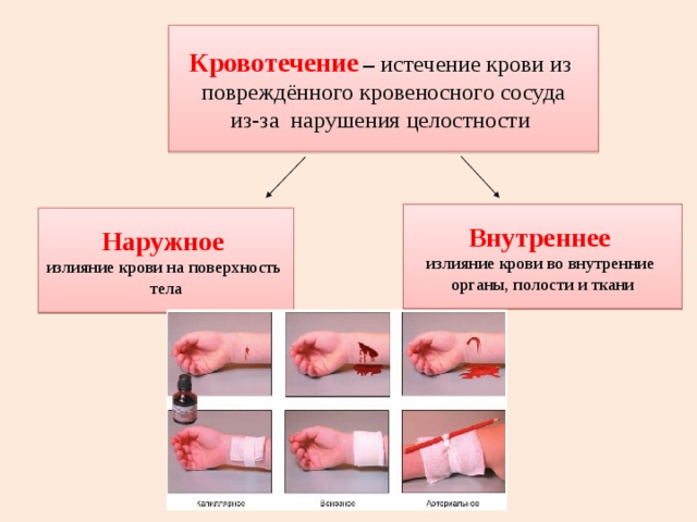 Кровотечение  – истечение крови из повреждённого кровеносного сосуда из-за нарушения целостности Внутреннее  излияние крови во внутренние органы, полости и ткани Наружное  излияние крови на поверхность тела 