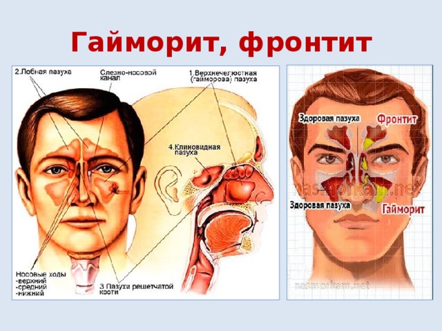 Гайморит, фронтит 