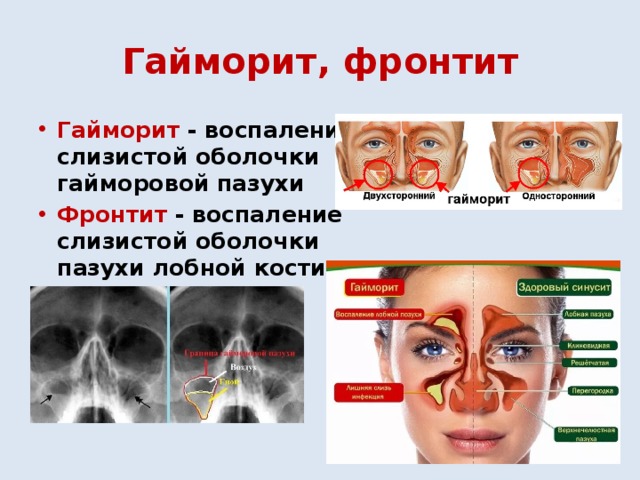 Гайморит, фронтит Гайморит - воспаление слизистой оболочки гайморовой пазухи Фронтит - воспаление слизистой оболочки пазухи лобной кости  