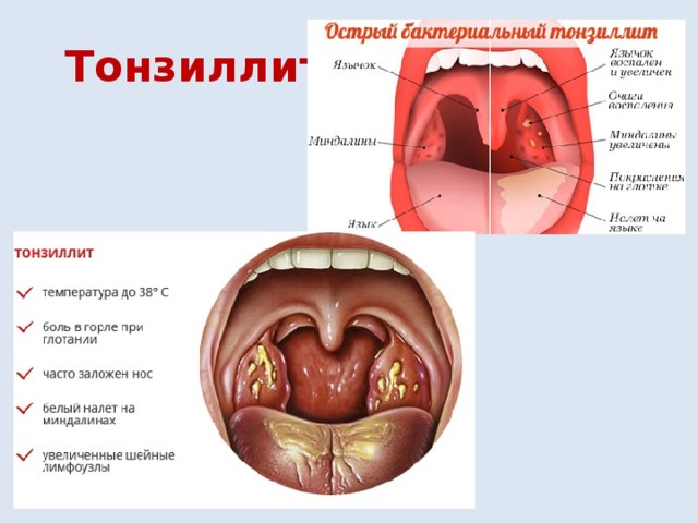 Тонзиллит 