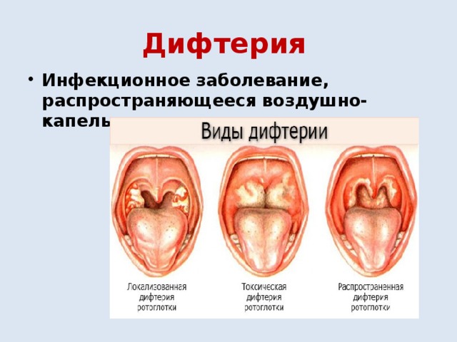 Дифтерия  Инфекционное заболевание, распространяющееся воздушно-капельным путем. 