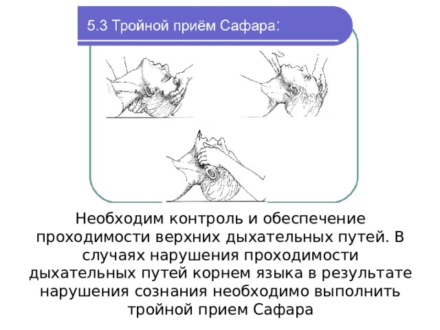 Необходим контроль и обеспечение проходимости верхних дыхательных путей. В случаях нарушения проходимости дыхательных путей корнем языка в результате нарушения сознания необходимо выполнить тройной прием Сафара 