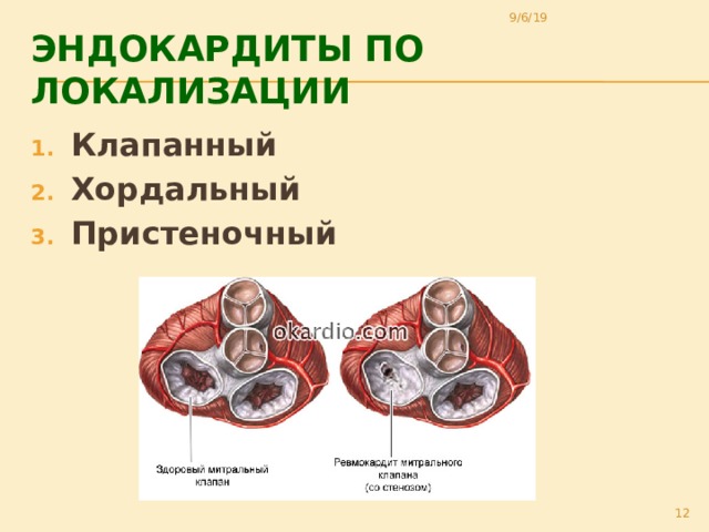 9/6/19 Эндокардиты По локализации Клапанный Хордальный Пристеночный 11 