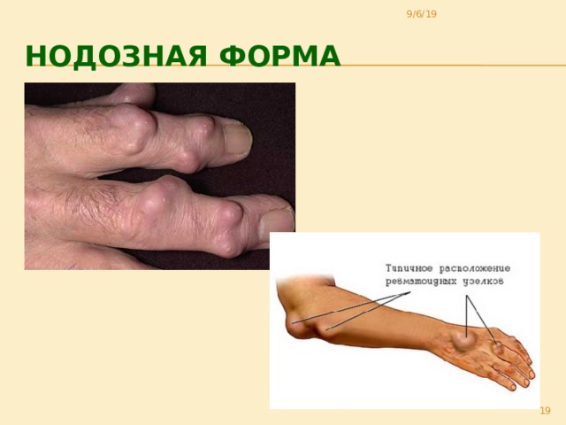 9/6/19 Нодозная форма 18 