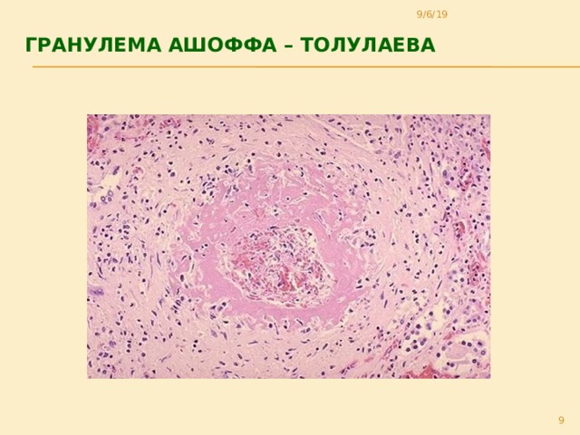 9/6/19 гранулема Ашоффа – Толулаева    8 