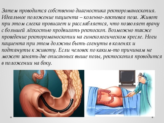 Затем проводится собственно диагностика ректороманоскопия. Идеальное положение пациента – коленно-локтевая поза. Живот при этом слегка провисает и расслабляется, что позволяет врачу с большей лёгкостью продвигать ректоскоп. Возможно также проведение ректороманоскопии на гинекологическом кресле. Ноги пациента при этом должны быть согнуты в коленях и подтянуты к животу. Если человек по каким-то причинам не может занять две описанных выше позы, ректоскопия проводится в положении на боку. 