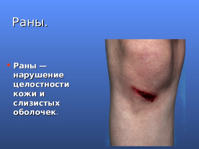 Раны. Раны — нарушение целостности кожи и слизистых оболочек .  Раны — нарушение целостности кожи и слизистых оболочек. Они разнообразны по размеру, форме, глубине и т.д.  