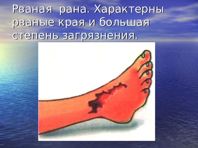 Рваная рана. Характерны рваные края и большая степень загрязнения. рваные раны являются следствием воздействия тупого предмета. Они характеризуются большим количеством размятых, ушибленных, пропитанных кровью тканей с нарушением их жизнеспособности.  