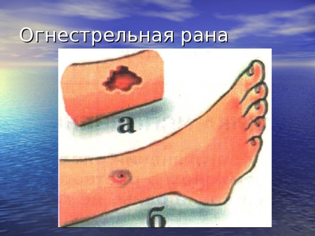 Огнестрельная рана Огнестрельные раны отличаются от всех остальных характером ранящего оружия (пуля, осколок); сложностью анатомической характеристики; особенностью повреждения тканей с зонами полного разрушения, некроза и молекулярного сотрясения; высокой степенью инфицированности; разнообразием характеристики (сквозные, слепые, касательные и др.).  