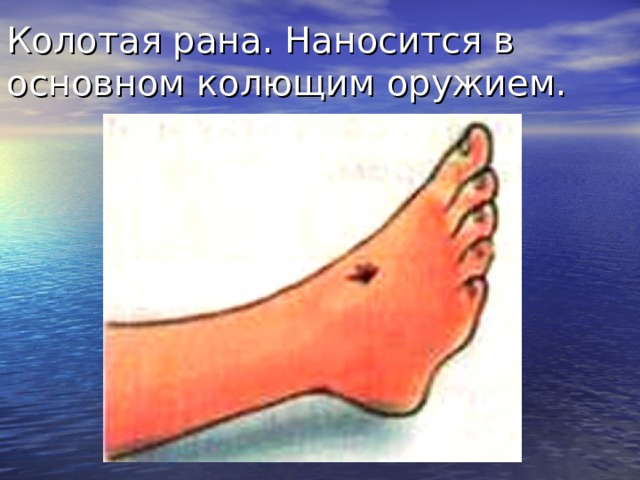 Колотая рана. Наносится в основном колющим оружием. Колотые раны наносят колющим оружием (штык, игла и др.). Анатомической особенностью их является значительная глубина при небольшом повреждении покровов. При этих ранах всегда имеется опасность повреждения жизненно важных структур, расположенных в глубине тканей, в полостях (сосуды, нервы, полые и паренхиматозные органы). Колотые раны опасны тем, что из-за бедности симптомов могут быть просмотрены повреждения глубоколежащих тканей и органов, поэтому необходимо особо тщательное обследование больного. Опасны колотые раны также тем, что с ранящим оружием в глубину тканей вносятся микроорганизмы, а раневое отделяемое, не находя выхода наружу, служит для них хорошей питательной средой, что создает особо благоприятные условия для развития гнойных осложнений.  