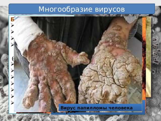 Многообразие вирусов Болезни человека:  свинка грипп оспа некоторые онкологические  (опухолевые) болезни желтая лихорадка бешенство полиомиелит энцефалит СПИД бородавки герпес  корь Ребенок, больной оспой Человек, больной герпесом Вирус гриппа увеличен в 300 раз Вирус папилломы человека 