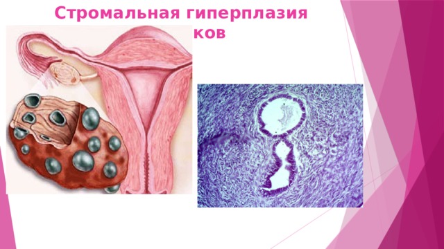 Стромальная гиперплазия яичников 