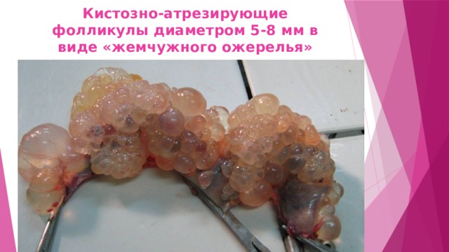 Кистозно-атрезирующие фолликулы диаметром 5-8 мм в виде «жемчужного ожерелья» 