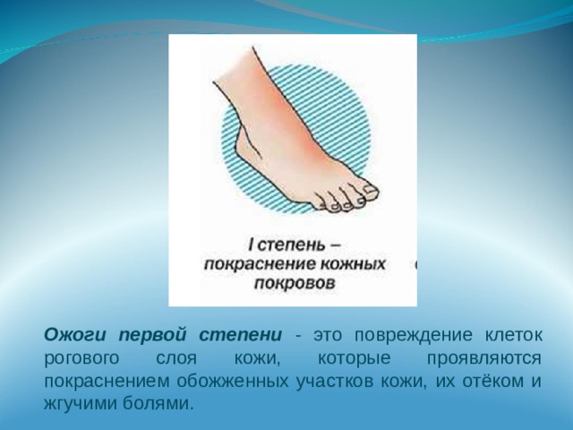 Ожоги первой степени - это повреждение клеток рогового слоя кожи, которые проявляются покраснением обожженных участков кожи, их отёком и жгучими болями. 
