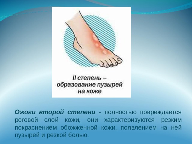 Ожоги второй степени - полностью повреждается роговой слой кожи, они характеризуются резким покраснением обожженной кожи, появлением на ней пузырей и резкой болью. 