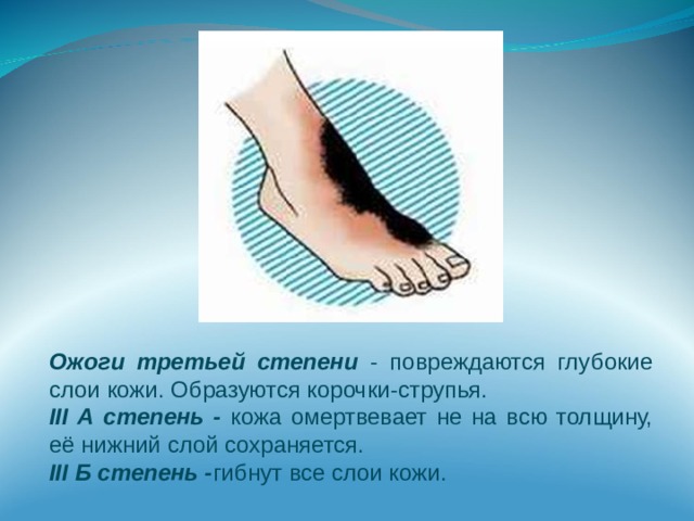 Ожоги третьей степени - повреждаются глубокие слои кожи. Образуются корочки-струпья. III А степень - кожа омертвевает не на всю толщину, её нижний слой сохраняется. III Б степень - гибнут все слои кожи. 