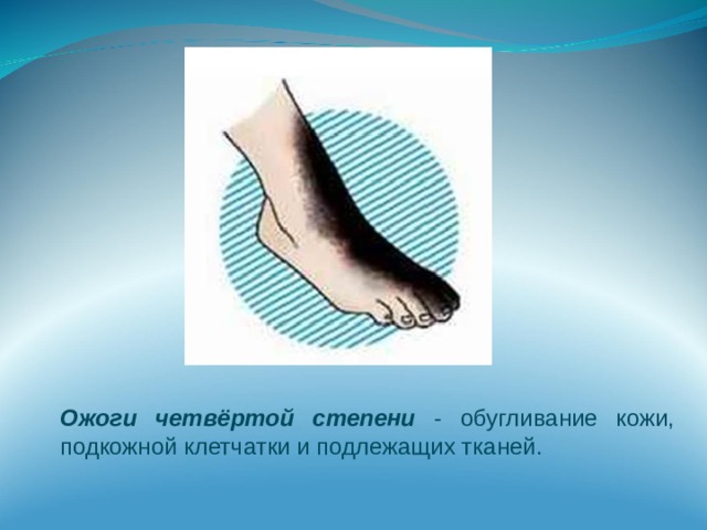 Ожоги четвёртой степени - обугливание кожи, подкожной клетчатки и подлежащих тканей. 