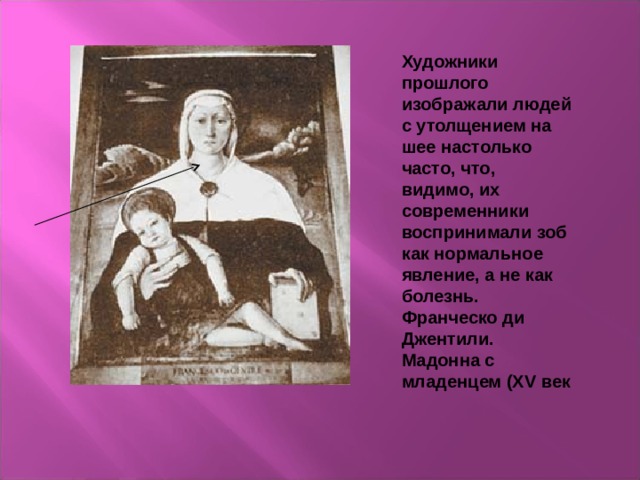Художники прошлого изображали людей с утолщением на шее настолько часто, что, видимо, их современники воспринимали зоб как нормальное явление, а не как болезнь.  Франческо ди Джентили. Мадонна с младенцем (XV век 
