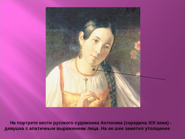  На портрете кисти русского художника Антонова (середина XIX века) - девушка с апатичным выражением лица. На ее шее заметно утолщение 