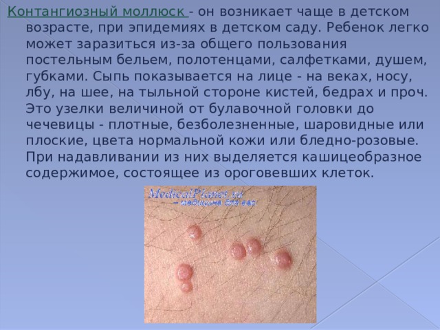 Контангиозный моллюск - он возникает чаще в детском возрасте, при эпидемиях в детском саду. Ребенок легко может заразиться из-за общего пользования постельным бельем, полотенцами, салфетками, душем, губками. Сыпь показывается на лице - на веках, носу, лбу, на шее, на тыльной стороне кистей, бедрах и проч. Это узелки величиной от булавочной головки до чечевицы - плотные, безболезненные, шаровидные или плоские, цвета нормальной кожи или бледно-розовые. При надавливании из них выделяется кашицеобразное содержимое, состоящее из ороговевших клеток. 