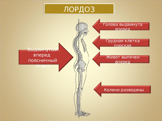 ЛОРДОЗ Голова выдвинута вперед Грудная клетка плоская Выдвинутый вперед поясничный отдел Живот выпячен вперед Колени разведены 