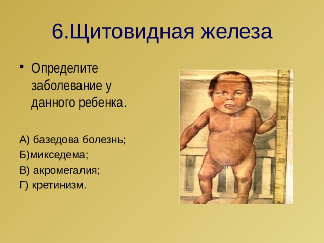 6.Щитовидная железа Определите заболевание у данного ребенка . А) базедова болезнь; Б)микседема; В) акромегалия; Г) кретинизм. 