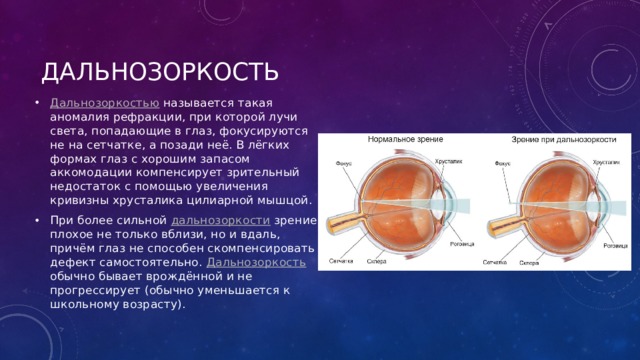 Дальнозоркость Дальнозоркостью называется такая аномалия рефракции, при которой лучи света, попадающие в глаз, фокусируются не на сетчатке, а позади неё. В лёгких формах глаз с хорошим запасом аккомодации компенсирует зрительный недостаток с помощью увеличения кривизны хрусталика цилиарной мышцой. При более сильной дальнозоркости зрение плохое не только вблизи, но и вдаль, причём глаз не способен скомпенсировать дефект самостоятельно. Дальнозоркость обычно бывает врождённой и не прогрессирует (обычно уменьшается к школьному возрасту). 