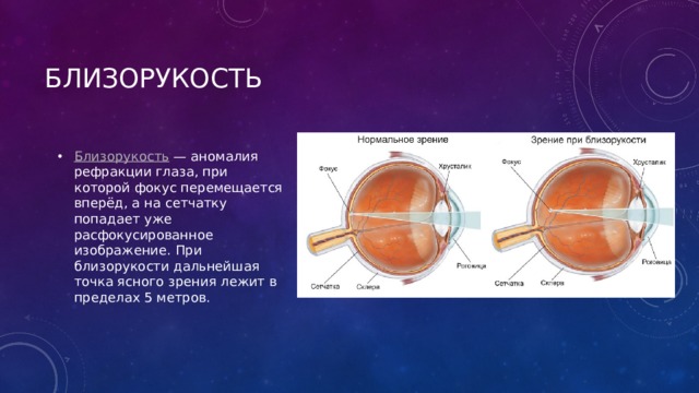 Близорукость Близорукость  — аномалия рефракции глаза, при которой фокус перемещается вперёд, а на сетчатку попадает уже расфокусированное изображение. При близорукости дальнейшая точка ясного зрения лежит в пределах 5 метров. 