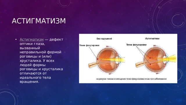 Астигматизм Астигматизм  — дефект оптики глаза, вызванный неправильной формой роговицы и (или) хрусталика. У всех людей формы роговицы и хрусталика отличаются от идеального тела вращения. 