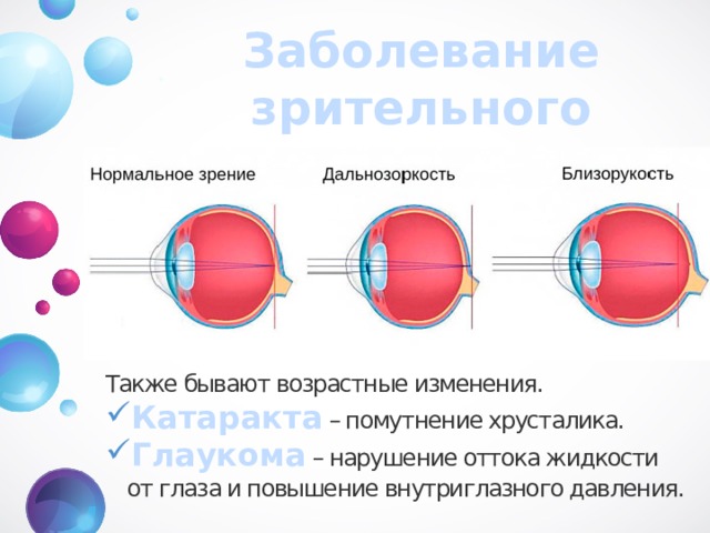 Заболевание зрительного анализатора Также бывают возрастные изменения. Катаракта – помутнение хрусталика. Глаукома – нарушение оттока жидкости от глаза и повышение внутриглазного давления.   