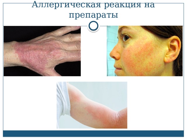 Аллергическая реакция на препараты 