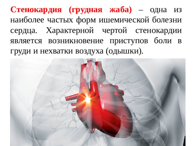 Стенокардия (грудная жаба) – одна из наиболее частых форм ишемической болезни сердца. Характерной чертой стенокардии является возникновение приступов боли в груди и нехватки воздуха (одышки). 