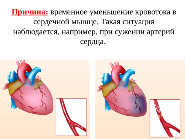 Причина:  временное уменьшение кровотока в сердечной мышце. Такая ситуация наблюдается, например, при сужении артерий сердца. 