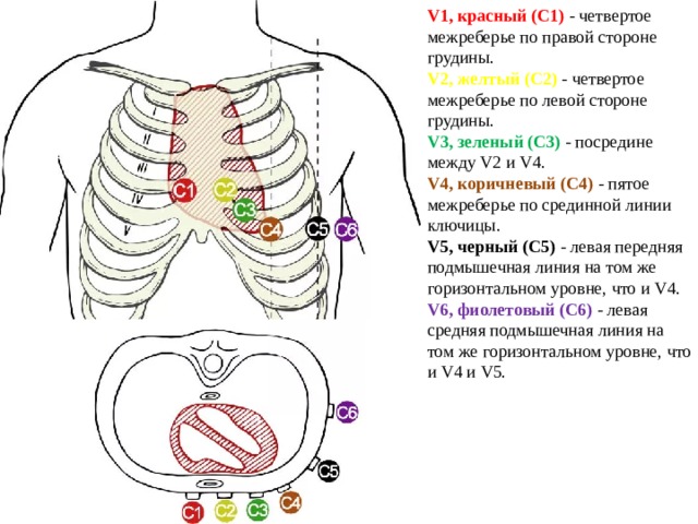 V1, красный (C1) - четвертое межреберье по правой стороне грудины. V2, желтый (C2) - четвертое межреберье по левой стороне грудины. V3, зеленый (C3) - посредине между V2 и V4. V4, коричневый (C4) - пятое межреберье по срединной линии ключицы. V5, черный (C5) - левая передняя подмышечная линия на том же горизонтальном уровне, что и V4. V6, фиолетовый (C6) - левая средняя подмышечная линия на том же горизонтальном уровне, что и V4 и V5. 