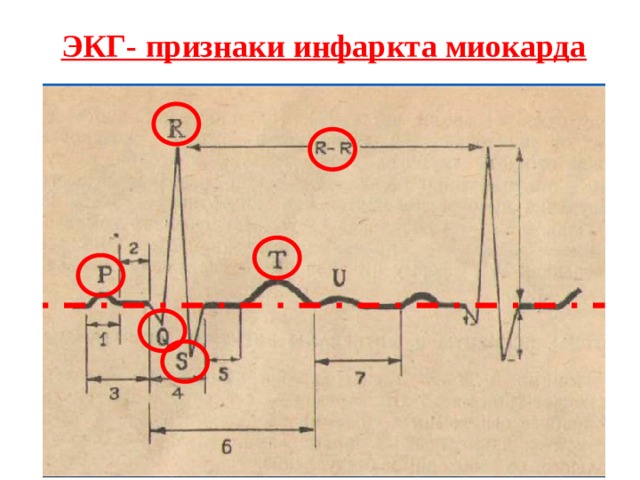 ЭКГ- признаки инфаркта миокарда 