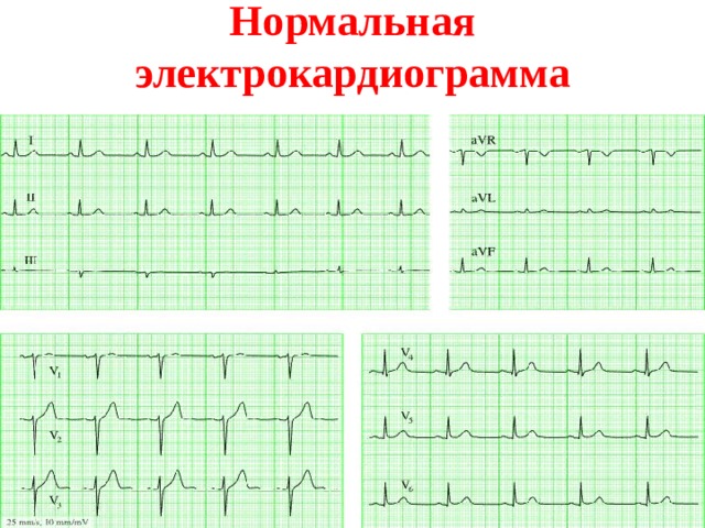 Нормальная электрокардиограмма 
