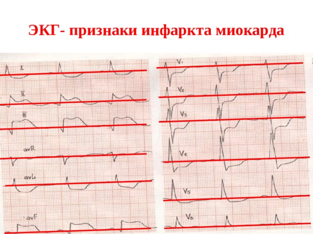 ЭКГ- признаки инфаркта миокарда 
