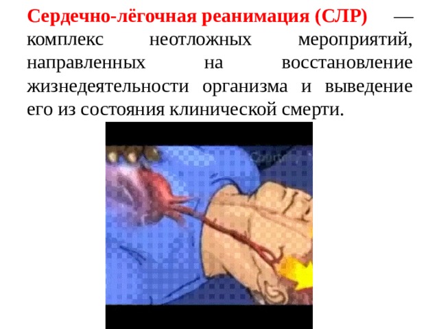 Сердечно-лёгочная реанимация (СЛР) — комплекс неотложных мероприятий, направленных на восстановление жизнедеятельности организма и выведение его из состояния клинической смерти. 