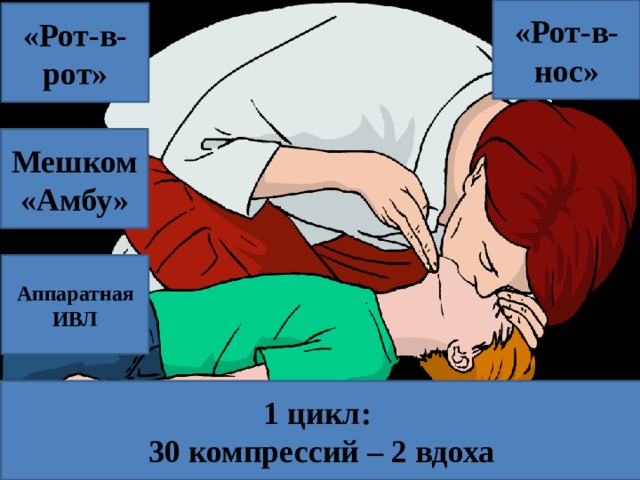 «Рот-в-нос» «Рот-в- рот» Мешком «Амбу» Аппаратная ИВЛ 1 цикл: 30 компрессий – 2 вдоха 