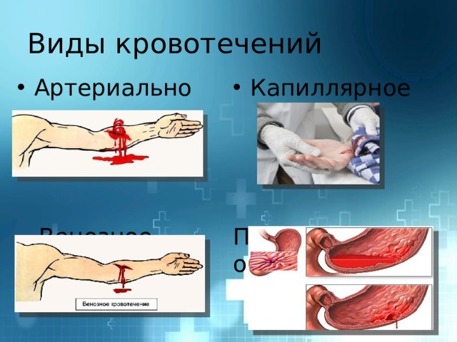 Виды кровотечений Капиллярное Артериальное  Венозное  Паренхиматозное 