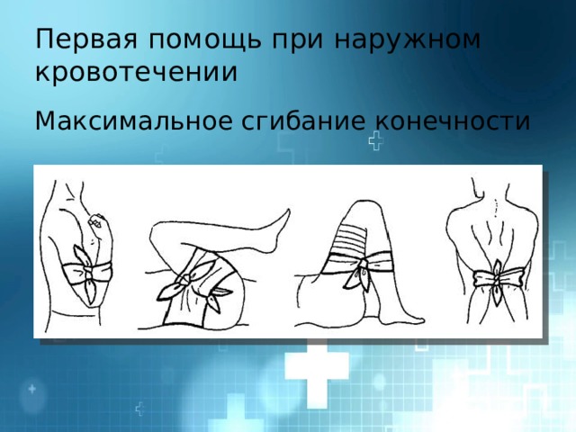 Первая помощь при наружном кровотечении Максимальное сгибание конечности 