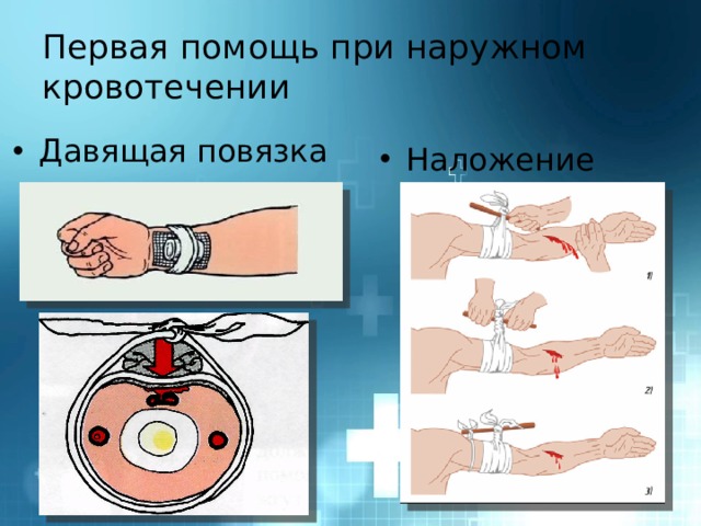 Первая помощь при наружном кровотечении Давящая повязка Наложение жгута 