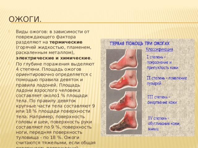 Ожоги. Виды ожогов: в зависимости от повреждающего фактора разделяют на термические (горячей жидкостью, пламенем, раскаленным металлом), электрические и химические . По глубине поражения выделяют 4 степени. Площадь ожогов ориентировочно определяется с помощью правила девяток и правила ладоней. Площадь ладони взрослого человека составляет около1 % площади тела. По правилу девяток крупные части тела составляют 9 или 18 % площади поверхности тела. Например, поверхность головы и шеи, поверхность руки составляют по 9 %, поверхность ноги, передняя поверхность туловища - по 18 %. Ожоги считаются тяжелыми, если общая поверхность повреждений составляет более 10 %. 