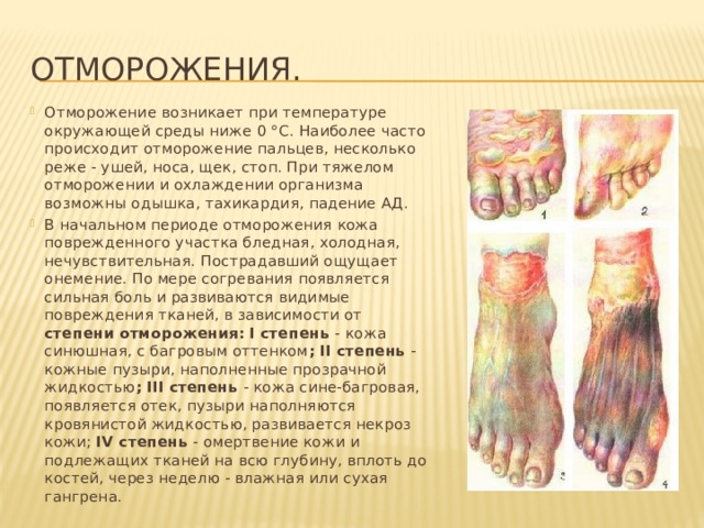 Отморожения. Отморожение возникает при температуре окружающей среды ниже 0 °С. Наиболее часто происходит отморожение пальцев, несколько реже - ушей, носа, щек, стоп. При тяжелом отморожении и охлаждении организма возможны одышка, тахикардия, падение АД. В начальном периоде отморожения кожа поврежденного участка бледная, холодная, нечувствительная. Пострадавший ощущает онемение. По мере согревания появляется сильная боль и развиваются видимые повреждения тканей, в зависимости от степени отморожения: I степень - кожа синюшная, с багровым оттенком ; II степень - кожные пузыри, наполненные прозрачной жидкостью ; III степень - кожа сине-багровая, появляется отек, пузыри наполняются кровянистой жидкостью, развивается некроз кожи; IV степень - омертвение кожи и подлежащих тканей на всю глубину, вплоть до костей, через неделю - влажная или сухая гангрена. 