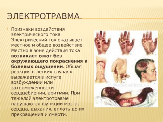 Электротравма. Признаки воздействия электрического тока: Электрический ток оказывает местное и общее воздействие. Местно в зоне действия тока возникает ожог без окружающего покраснения и болевых ощущений . Общая реакция в легких случаях выражается в испуге, возбуждении или заторможенности, сердцебиении, аритмии. При тяжелой электротравме нарушаются функции мозга, сердца, дыхания, вплоть до их прекращения и смерти. 