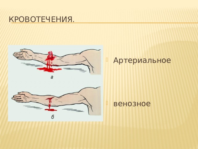 Кровотечения. Артериальное венозное 