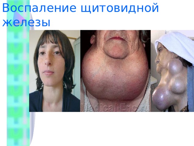 Воспаление щитовидной железы 