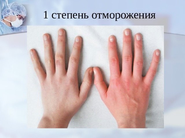 1 степень отморожения 