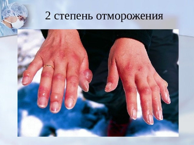 2 степень отморожения 