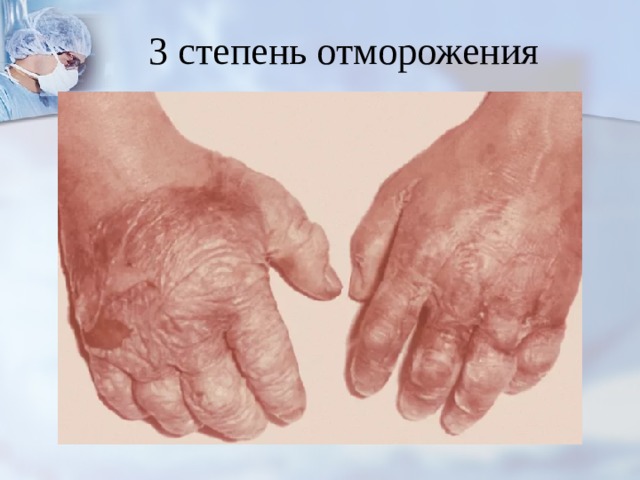 3 степень отморожения 
